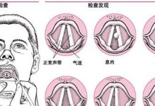 声带摘除的必要性与影响（探讨声带摘除的原因、影响以及潜在风险）