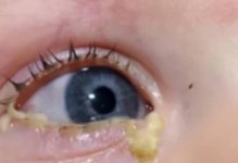 眼睛分泌粘稠物的原因（探究眼睛分泌粘稠物的成因和解决方法）