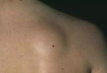 身上为什么容易长脂肪瘤？（脂肪瘤形成原因及影响因素）