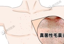 胸前长脓的原因及治疗方法（探讨胸前长脓引起的病因及有效疗法）